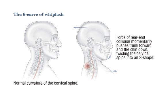 s-curve of whiplash